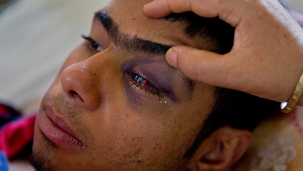 Kashmiiri youth Tabish Butt injured in the eye by a pellet fired an Indian trooper. 