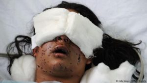 A Kashmiri girl with a face pockmarked by pellets and eyes damaged 