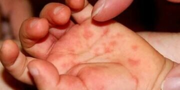 hand, foot and mouth disease