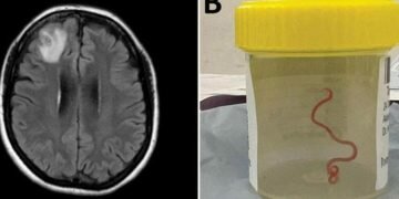Live worm found in Australian woman’s brain in world first