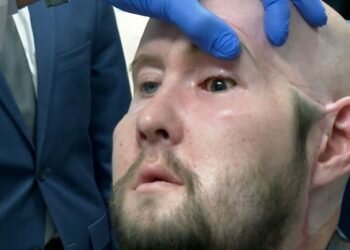World’s first whole-eye transplant hailed as breakthrough